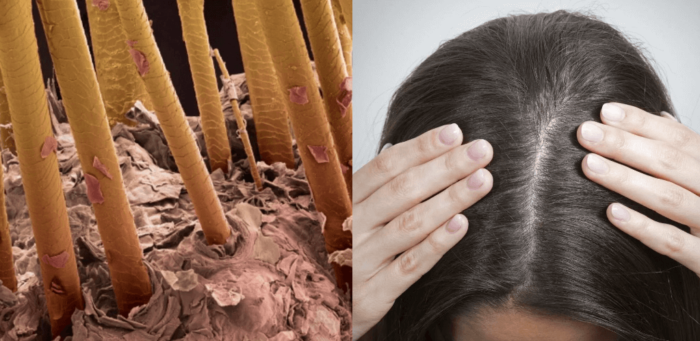 Причини появи лупи