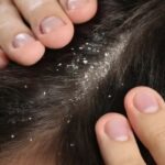 Як позбутися лупи: лікування шкіри голови в домашніх умовах