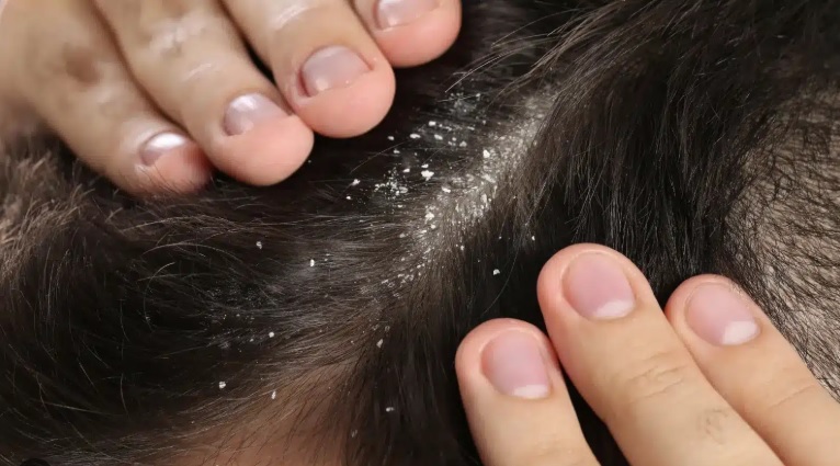 Як позбутися лупи: лікування шкіри голови в домашніх умовах